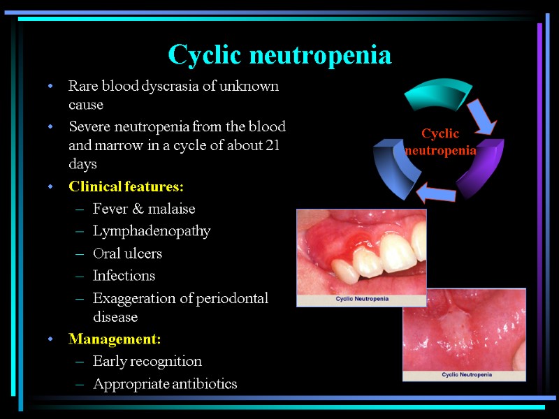 Cyclic neutropenia Rare blood dyscrasia of unknown cause Severe neutropenia from the blood and